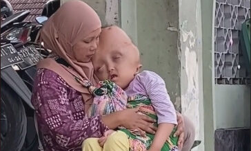 Ibu Siti mengurus anaknya selama 9 tahun yang tekena penyakit Hidrosefalus